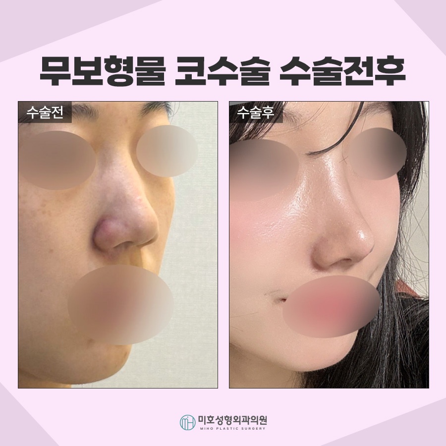 무보형물코수술 자연스러운 라인을 원한다면 관련 이미지 7