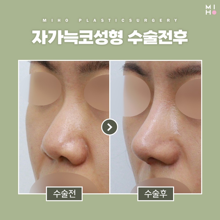 자가늑코수술 나에게 적합한 방식으로 관련 이미지 9