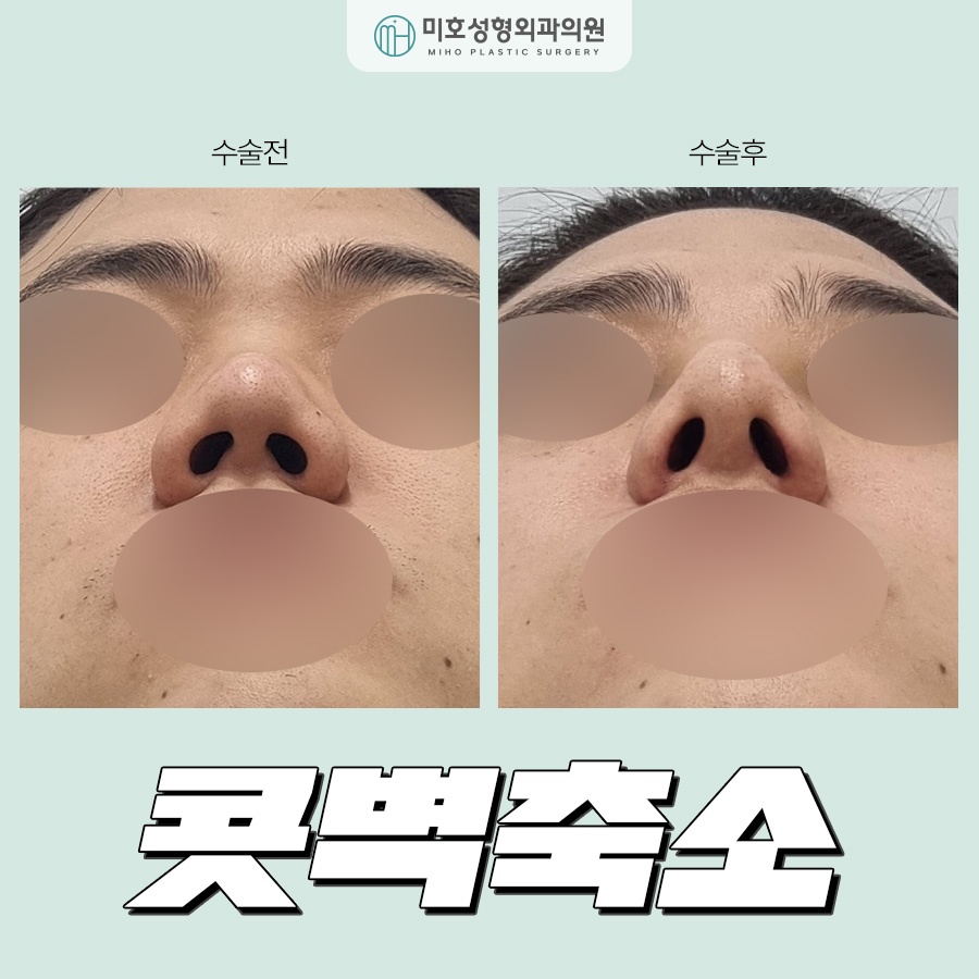 Comprehensive Guide to Alar Reduction Procedure and Aftercare image 1