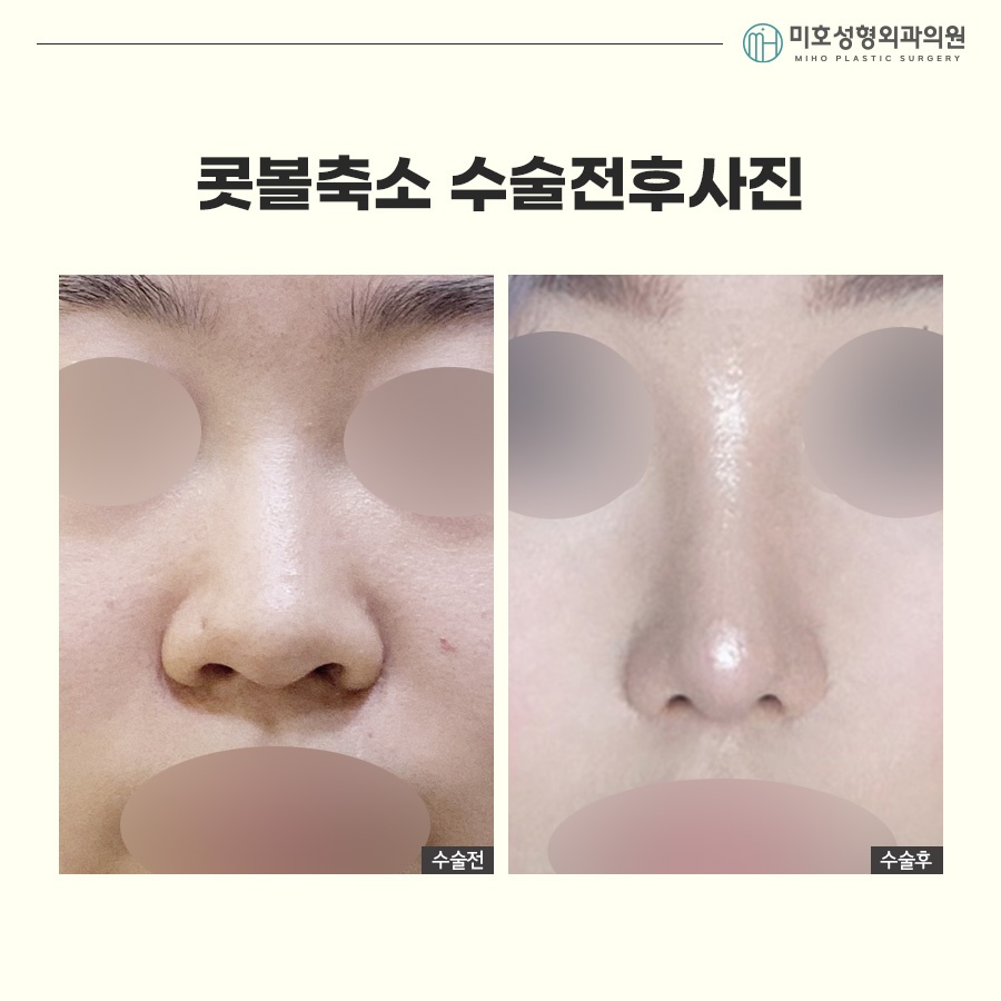 How to Make Your Nostrils Look Smaller: Considering Facial Harmony image 10
