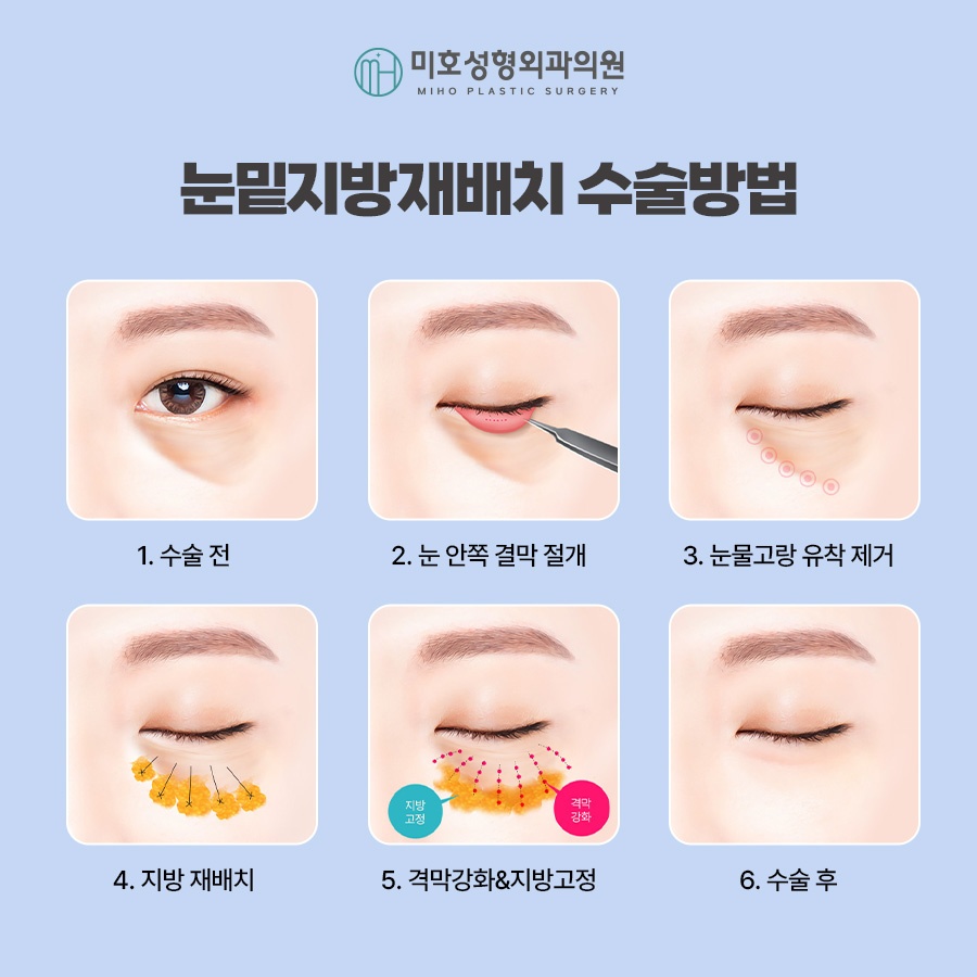 Miho Signature Lower Eyelid Fat Repositioning: The Beginning of Youth image 5