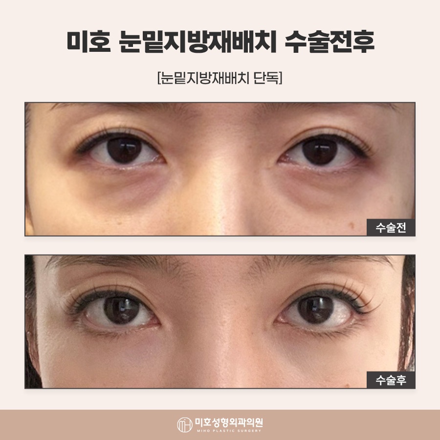 눈밑지방재배치수술후 회복 흐름 살펴봐야 관련 이미지 9