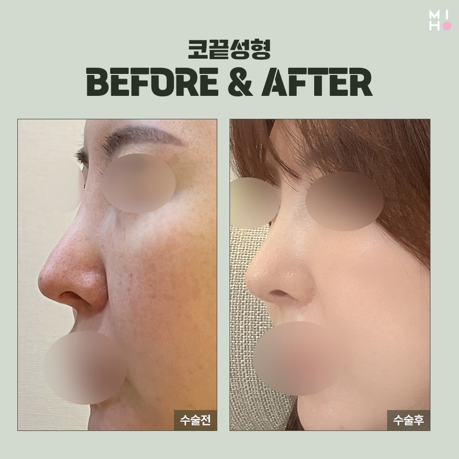 코끝연골묶기 복코 교정을 위한 과정 관련 이미지 11