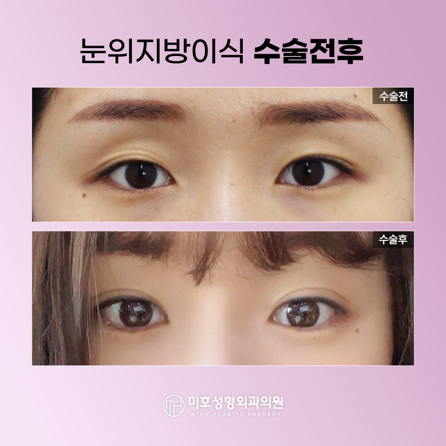 How to Naturally Improve Sunken Upper Eyelids image 6