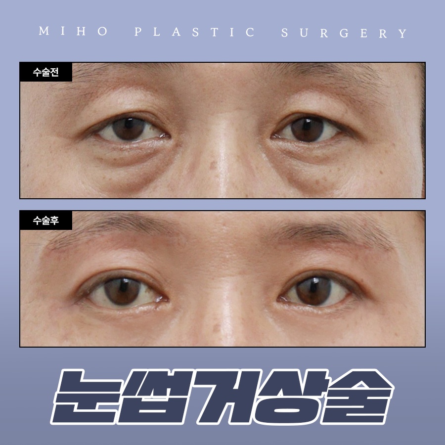 눈썹거상술 잘못된 오해와 장단점 관련 이미지 1