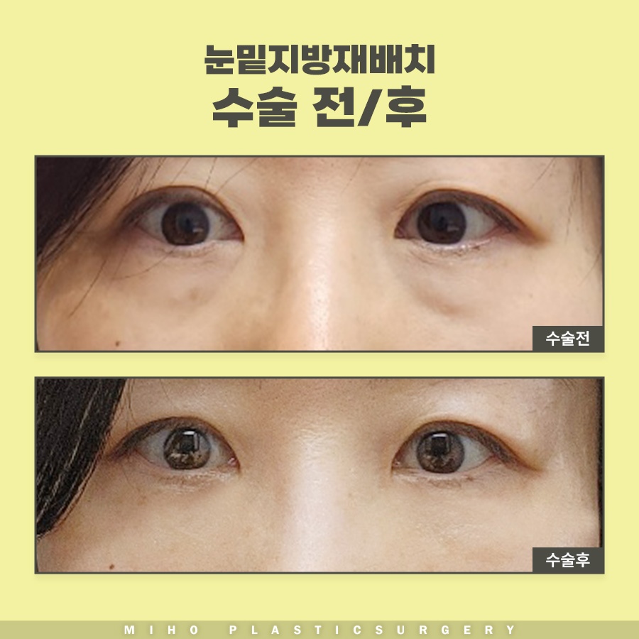 눈밑지방재배치수술비용 내게 맞는 수준은 관련 이미지 9