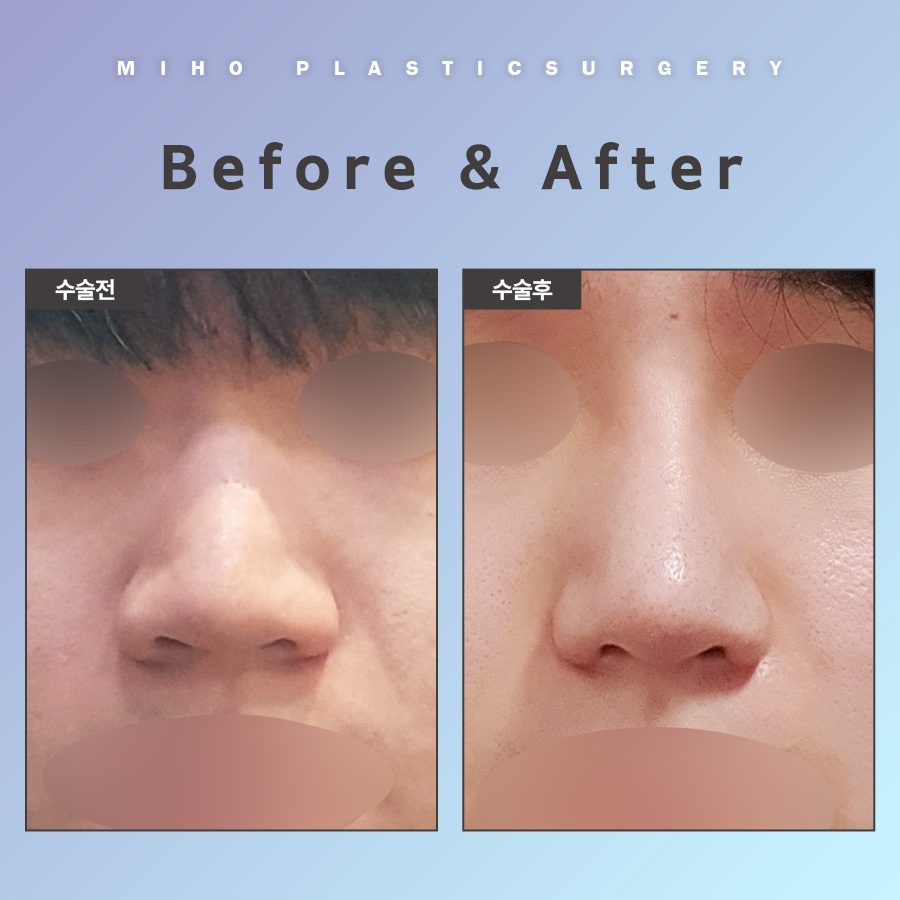Natural-Looking Alar Reduction with Minimal Incisions image 8