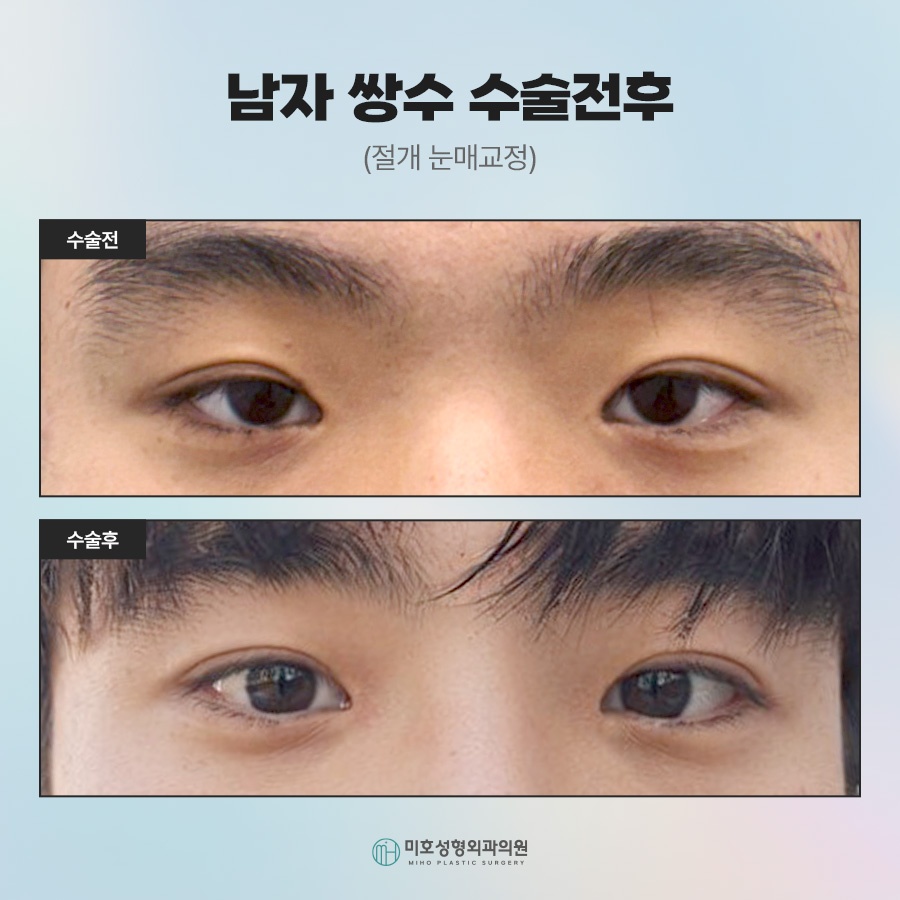What Men Considering Double Eyelid Surgery Should Know image 8