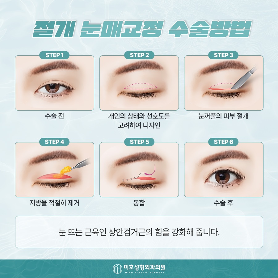 Natural-Looking Male Eye Shape Correction image 5