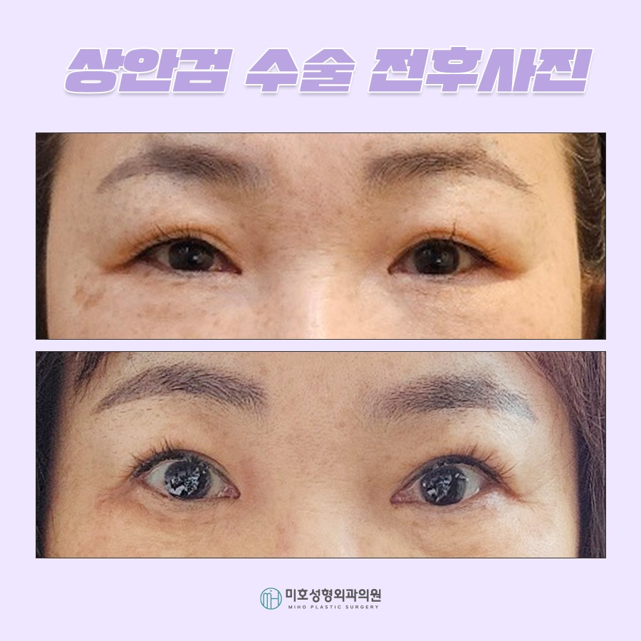상안검수술 해당하는 유형은 관련 이미지 6