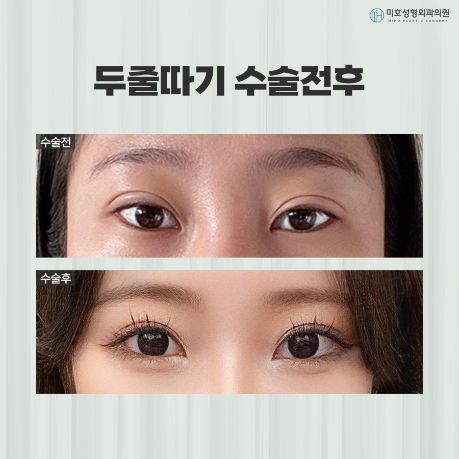 Differences Between One-Line and Two-Line Correction and Causes of Sausage Eyes image 7