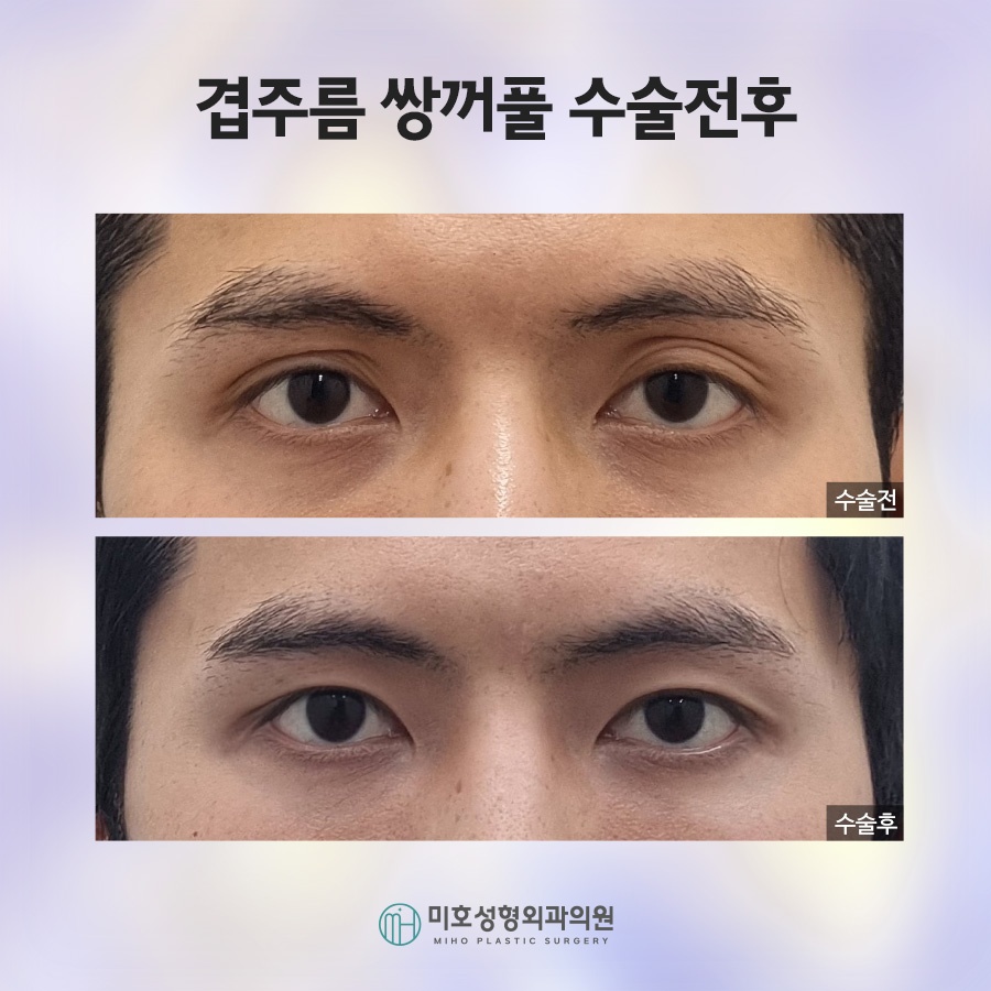 겹쌍꺼풀 깔끔하게 정돈하려면 관련 이미지 7