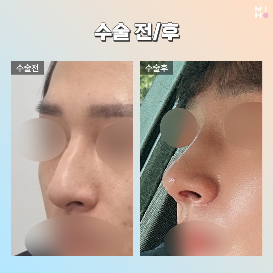 Good Results at a Lower Cost with Functional Nasal Surgery Insurance Coverage image 9