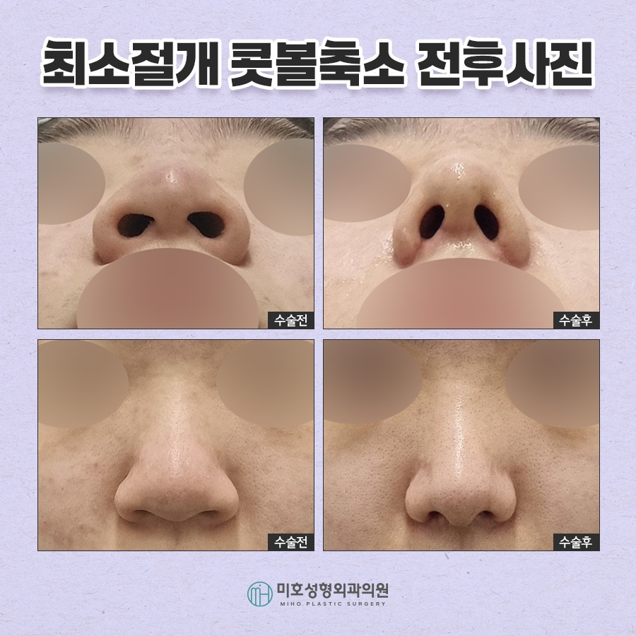 Refining Nostril Reduction in a Sophisticated Way image 8