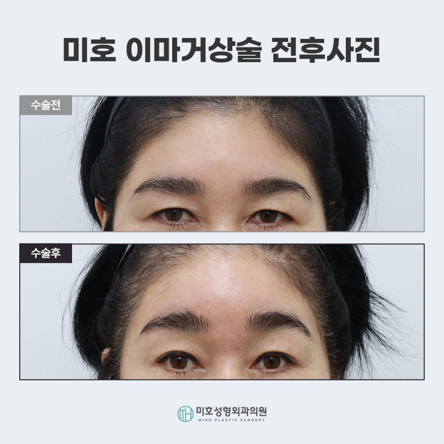이마거상비용 방법 비교 관련 이미지 10