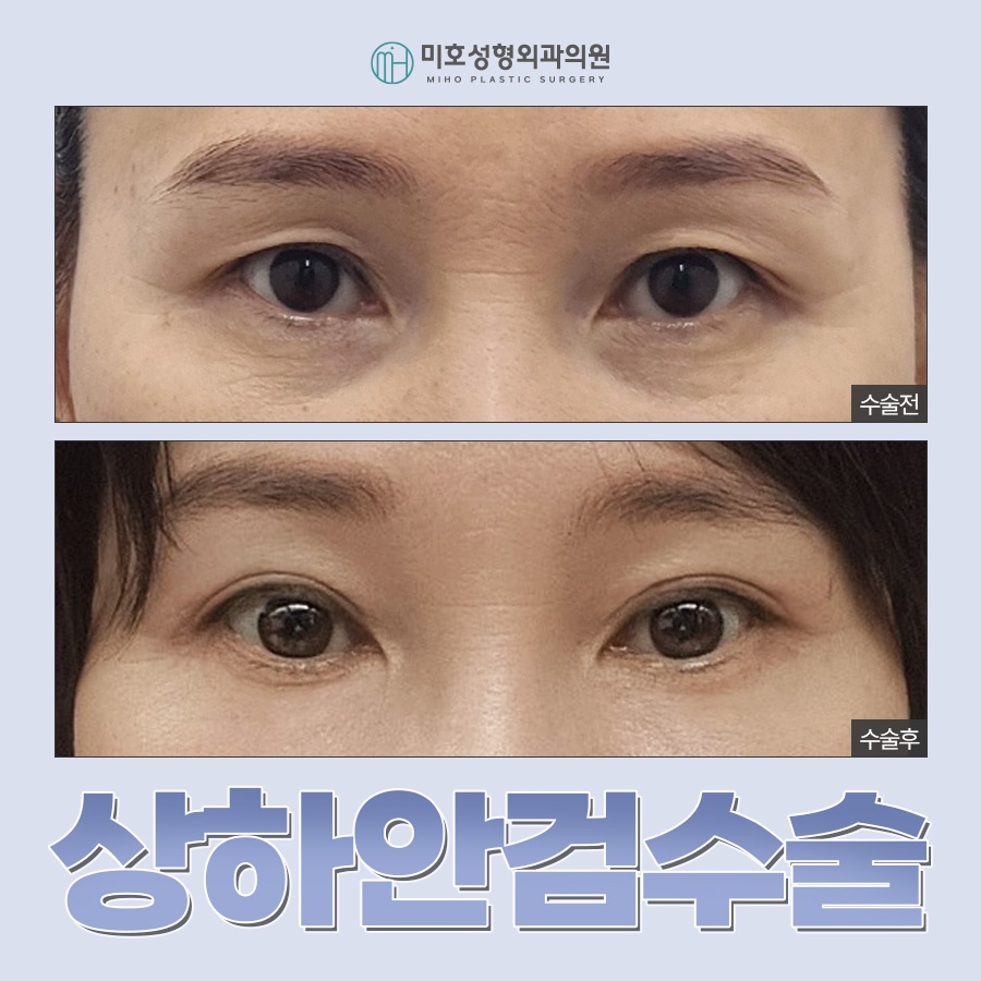 An In-Depth Analysis of Upper and Lower Blepharoplasty image 1