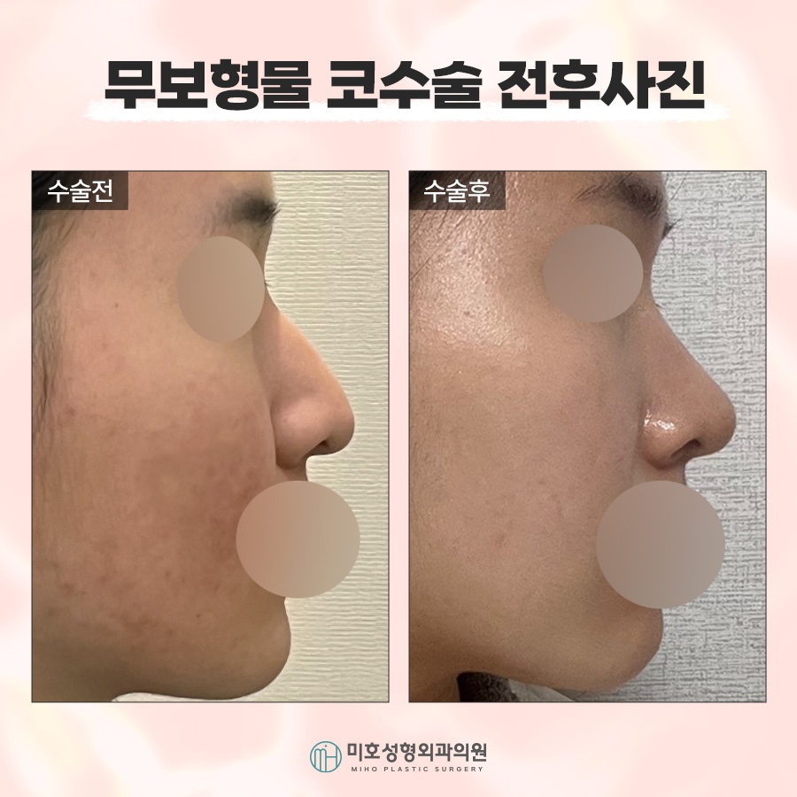 If You Want Harmonious Lines with Nose Surgery Without Implants image 7