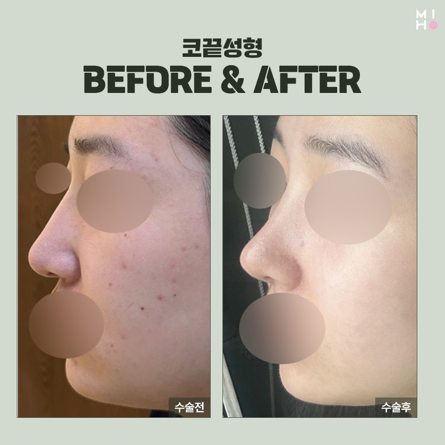 코끝연골묶기 복코 교정을 위한 과정 관련 이미지 10