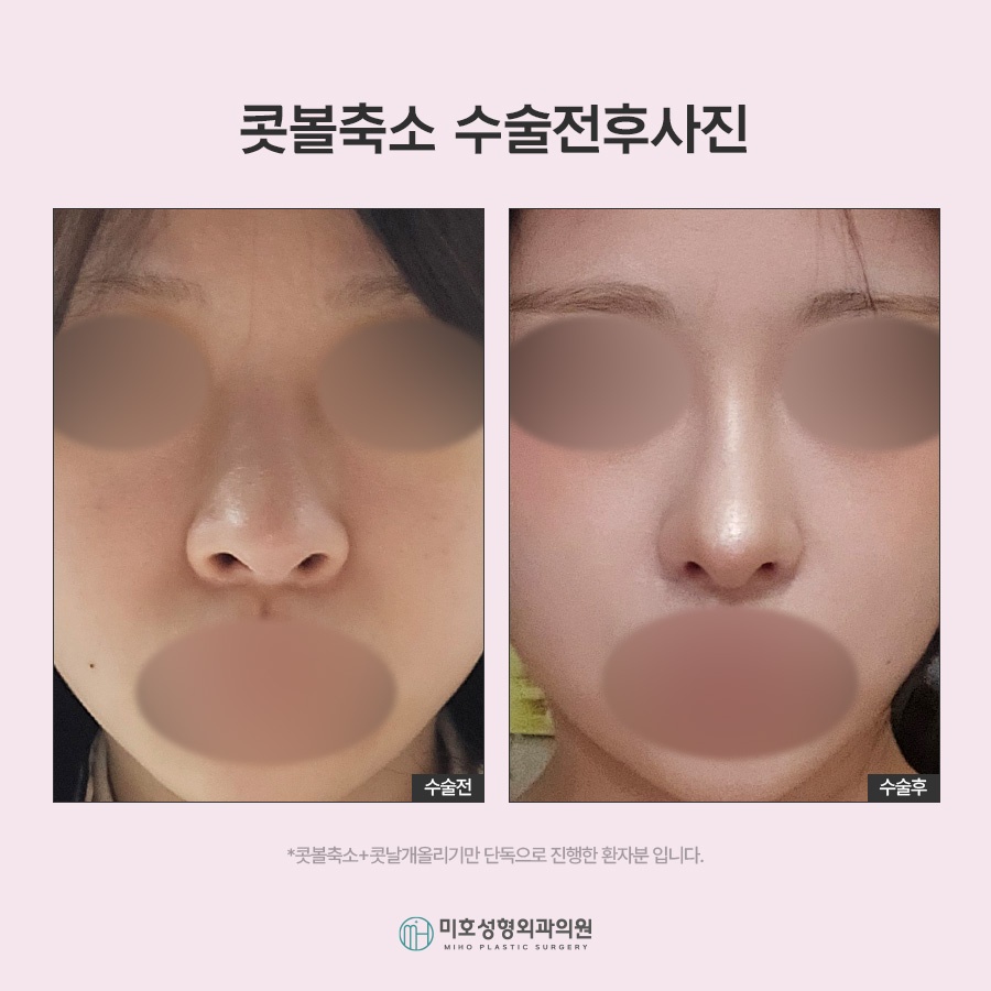 콧볼축소 자연스러운 코라인을 위한 체크포인트 관련 이미지 9