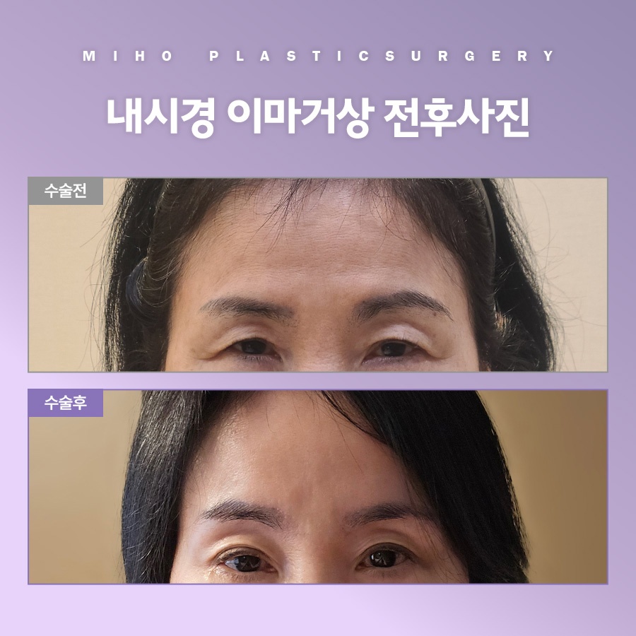 이마거상 비용 및 사후관리 팁 관련 이미지 10