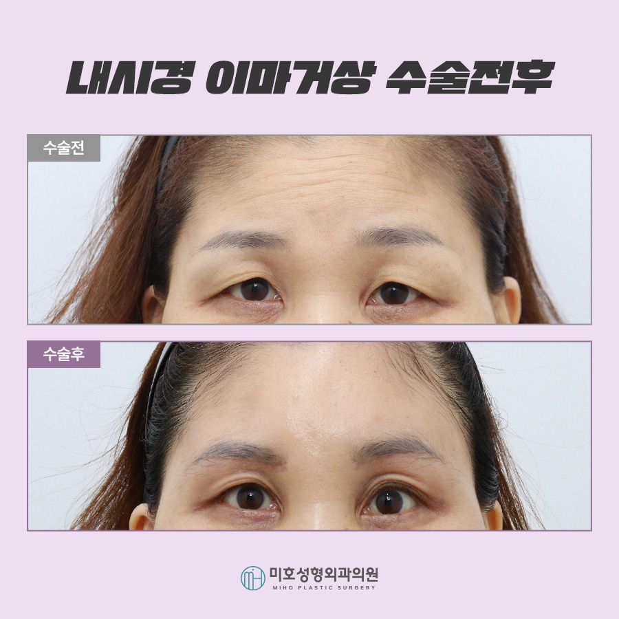 Forehead Lift Surgery Review: Tailored to Sagging Areas image 8