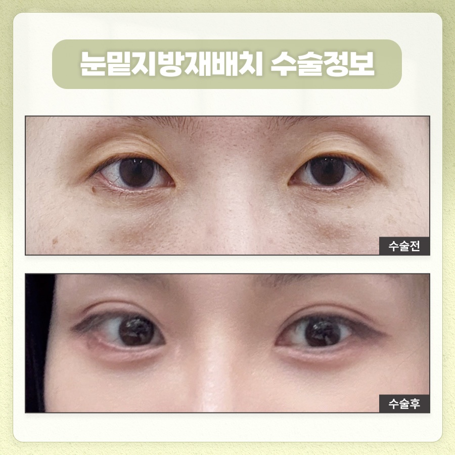 눈밑지방재배치 피로한 인상을 관련 이미지 7