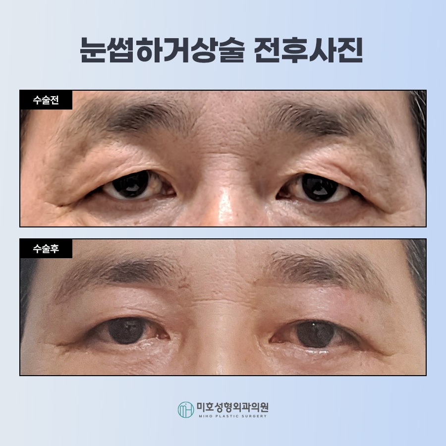 눈썹하거상술 처진 눈 개선 관련 이미지 6