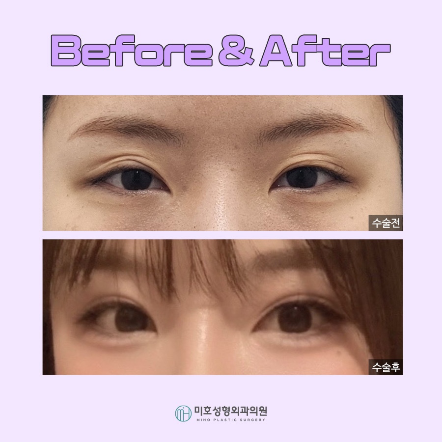 A Clean, Smooth Line for Double Eyelid Folds image 9