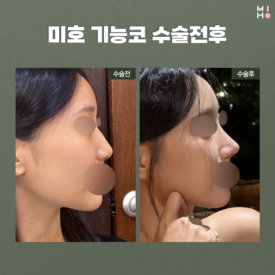 비중격만곡증 비용부담은 줄이고 만족도는 높여요 관련 이미지 8