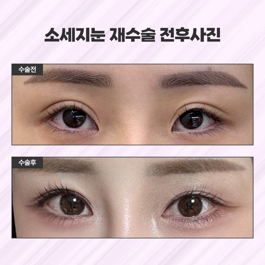 소세지눈재수술 적용 방식 2가지 관련 이미지 9