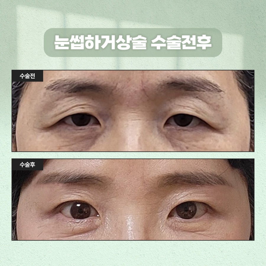 How to Tidy Up Drooping Eyes with Sub-Brow Lift Surgery image 7