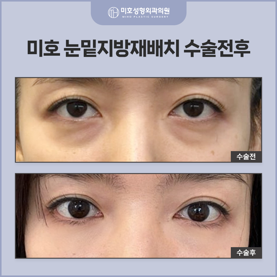 Improving Dark Circles Under the Eyes with Under-Eye Fat Repositioning to Create a More Vibrant Eye Area image 8