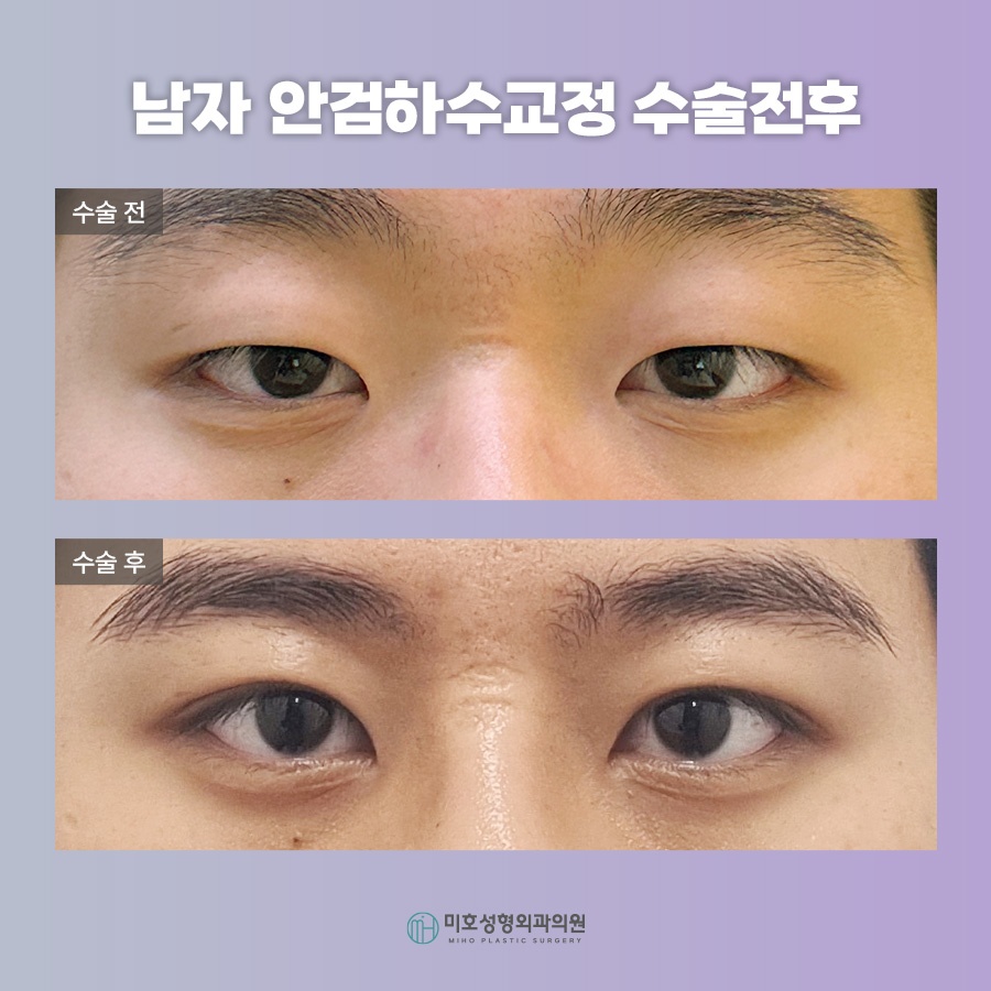 남자안검하수 자연스러움을 바탕으로 관련 이미지 10