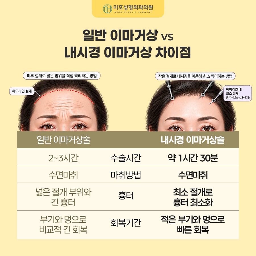 내시경이마거상 부기와 회복기간, 유지기간까지 알아보기 관련 이미지 4