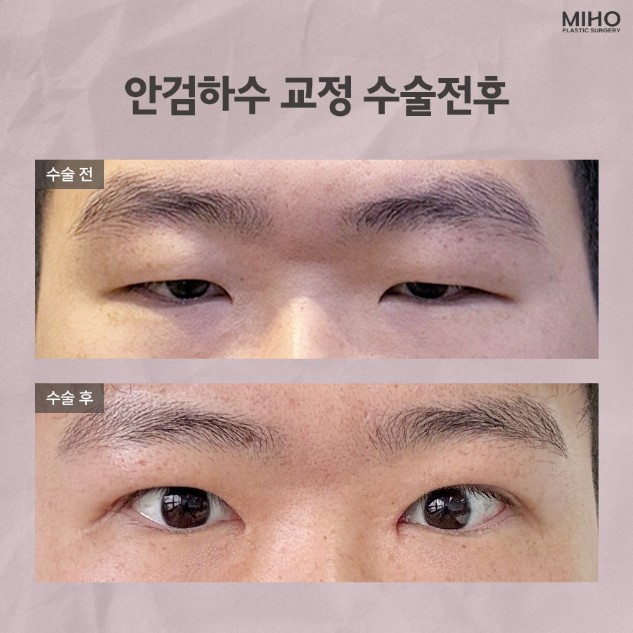 안검하수 발생 요인과 증상에 맞춰 관련 이미지 10