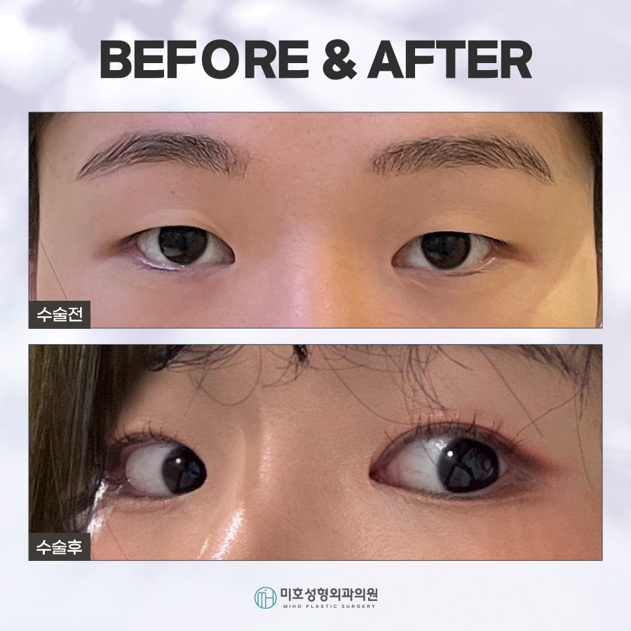속쌍눈매교정에 관심을 두고 있다면 관련 이미지 7