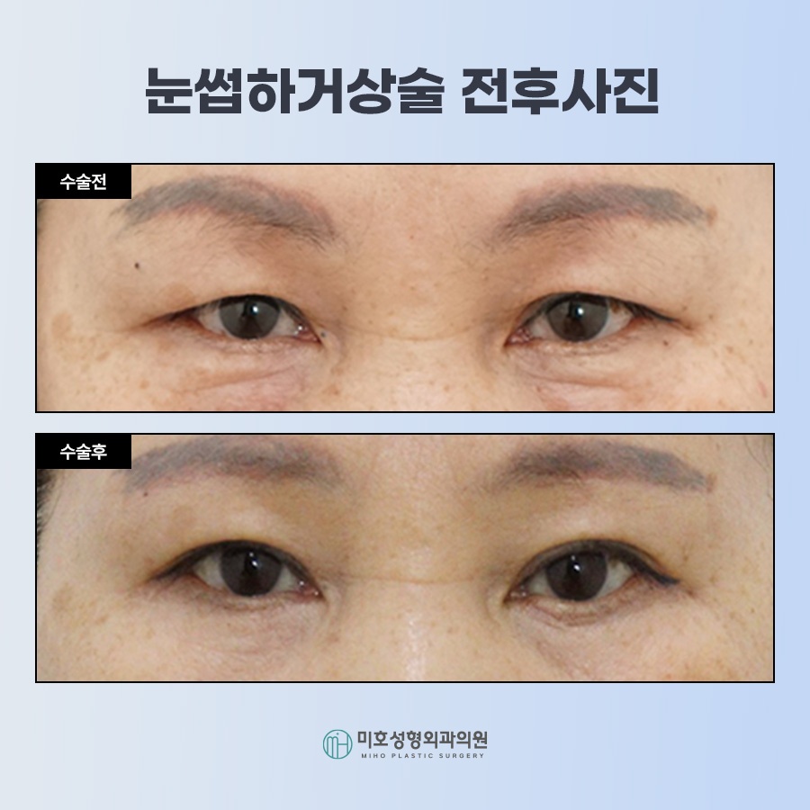 눈썹하거상술 처진 눈 개선 관련 이미지 9