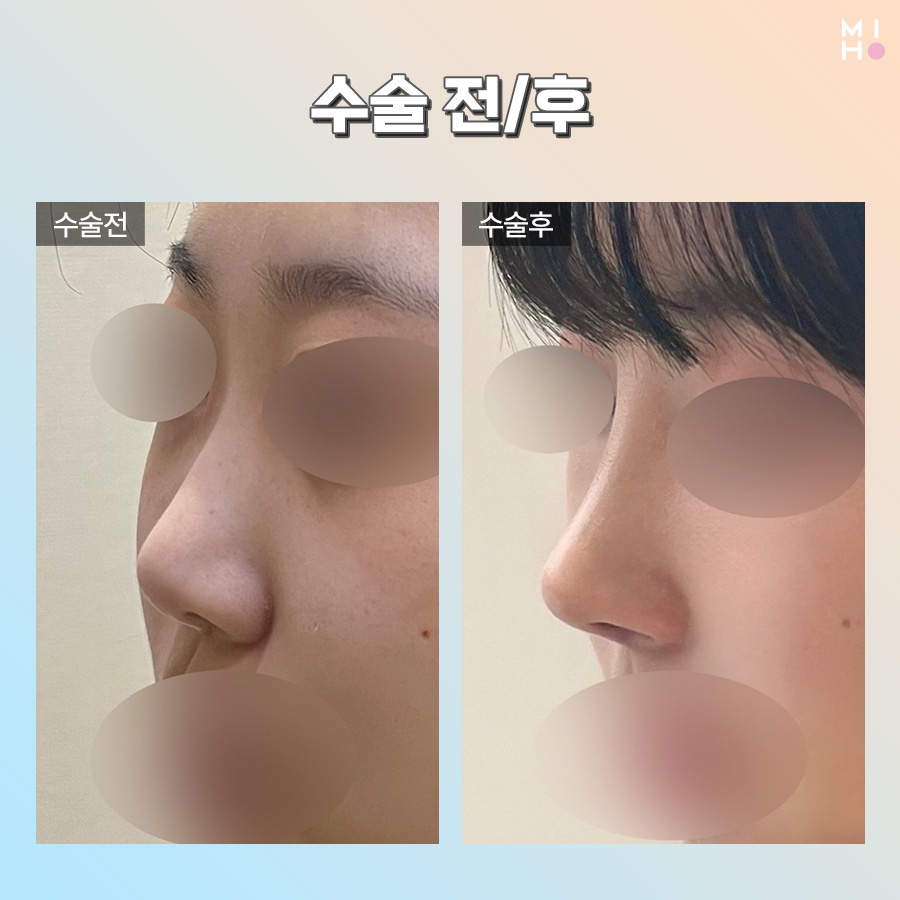 Good Results at a Lower Cost with Functional Nasal Surgery Insurance Coverage image 10