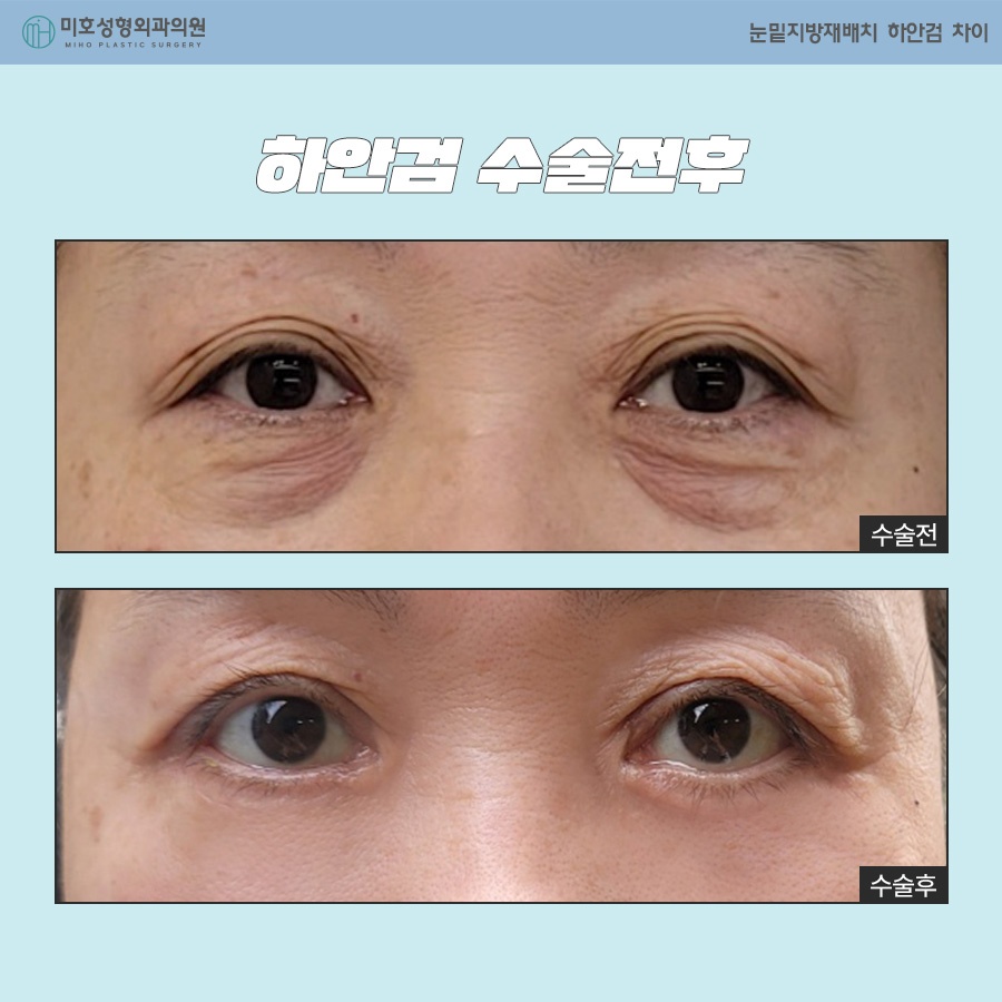 How to Choose Between Under-Eye Fat Repositioning and Lower Blepharoplasty image 10