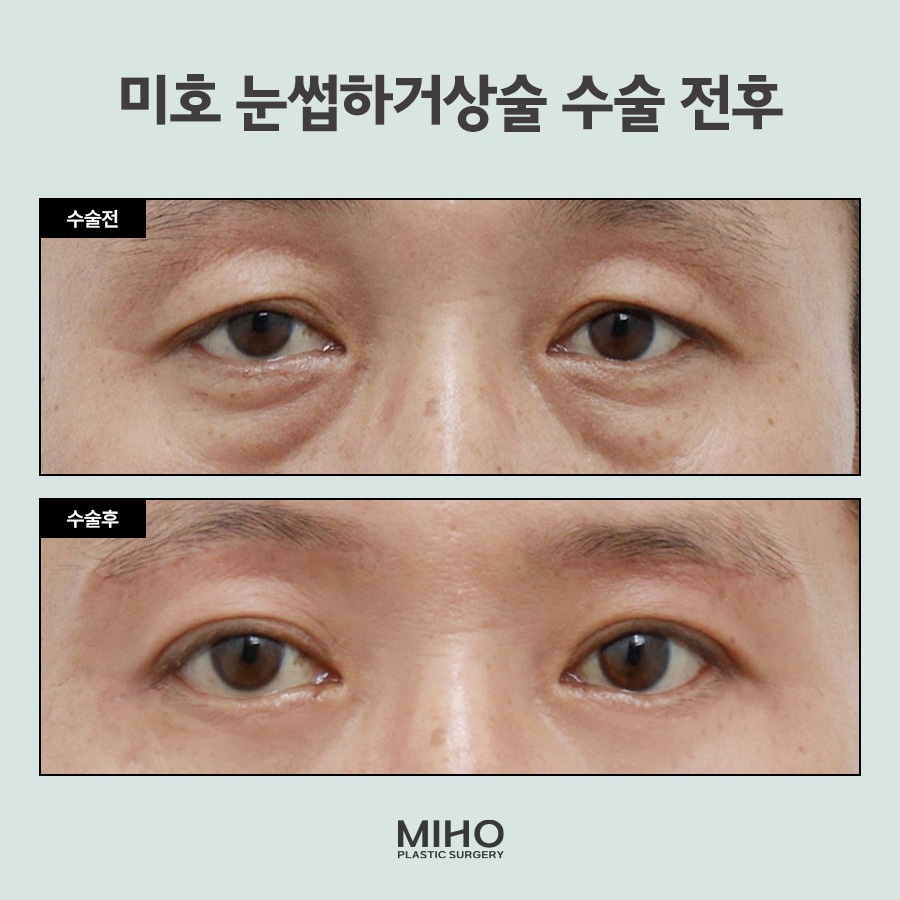 Sub-Brow Lift Scar, Cost, Recovery Process, Information, and Review image 8