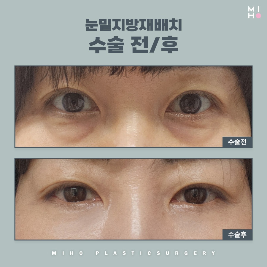 눈밑지방재배치 호감형 인상으로 개선하려면 관련 이미지 8