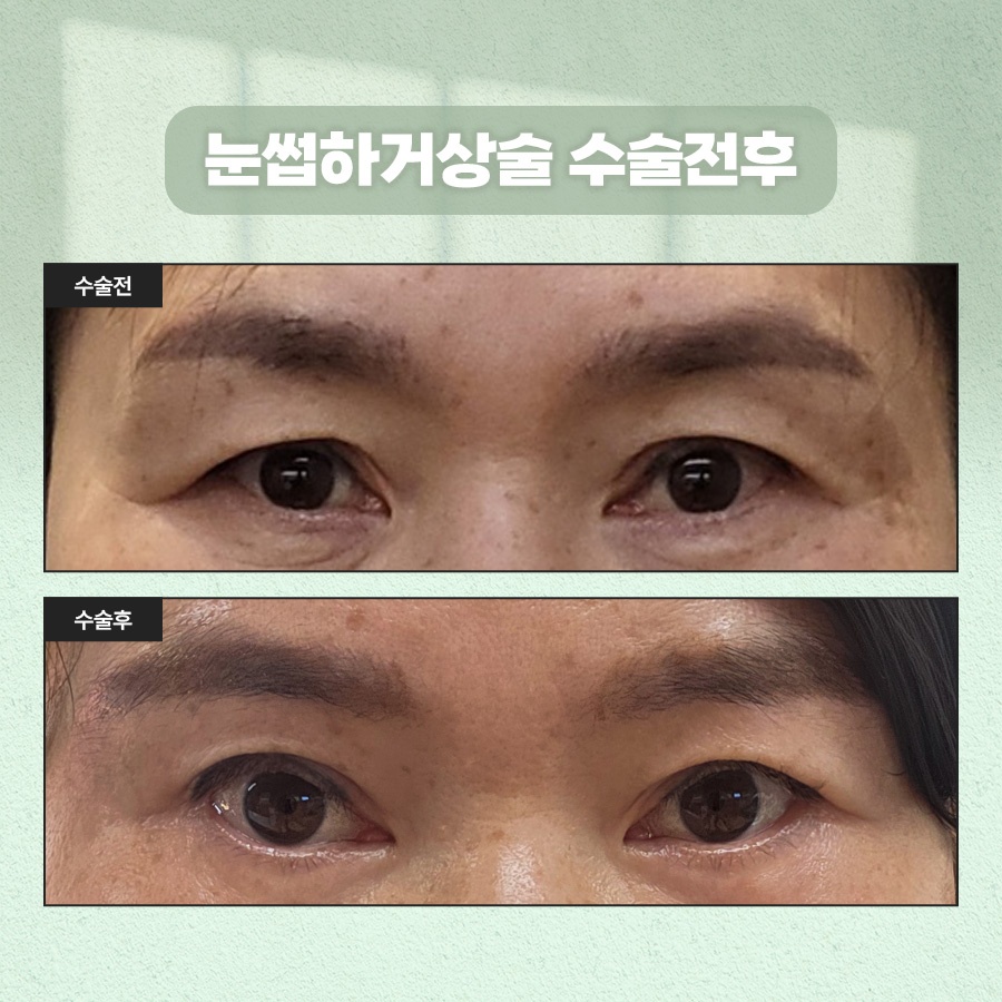 How to Tidy Up Drooping Eyes with Sub-Brow Lift Surgery image 9