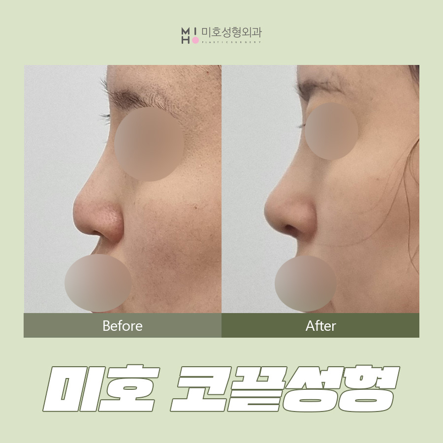 코끝성형 오똑하고 자연스럽게 관련 이미지 1