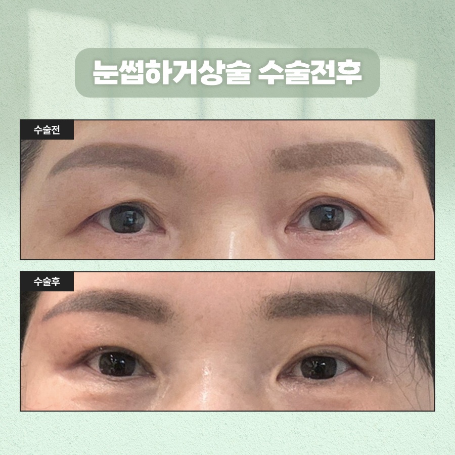 How to Tidy Up Drooping Eyes with Sub-Brow Lift Surgery image 8