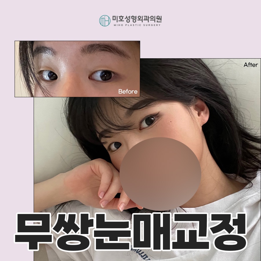 How to Make Your Eyes Bigger Without Double Eyelids: Ptosis Correction for Monolids image 1