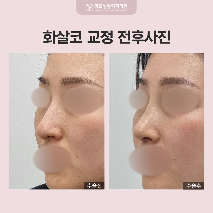 화살코 형태의 원인과 개선 방법 관련 이미지 9