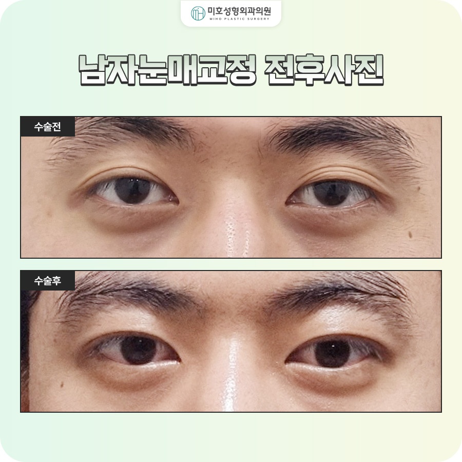 남자눈매교정 졸려 보이는 인상이 고민이라면 관련 이미지 8