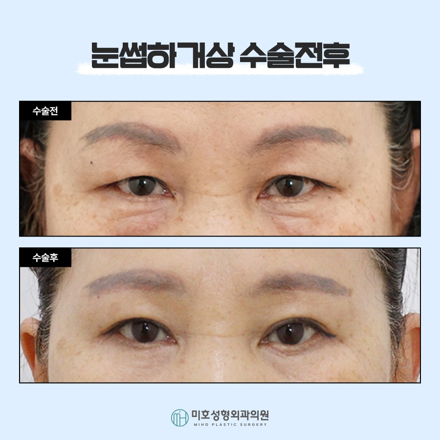 눈썹하거상 노안형 얼굴에 변화를 주려면 관련 이미지 6