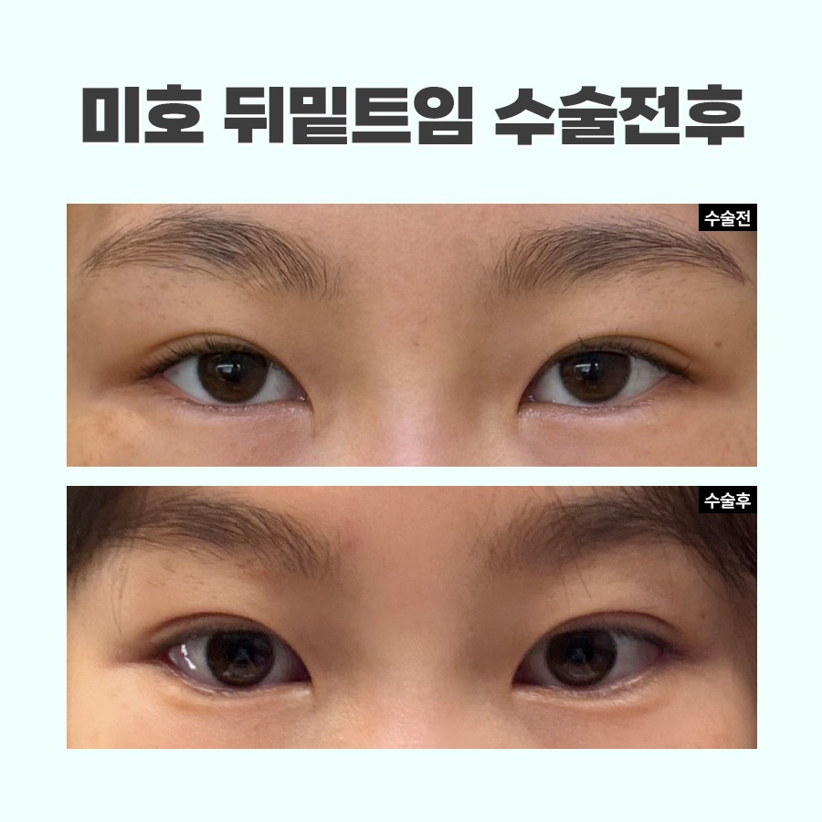 뒷트임밑트임후기 주의할 점 관련 이미지 9