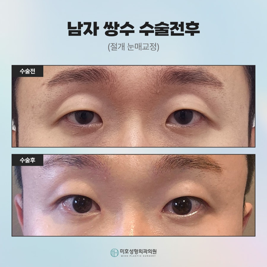 What Men Considering Double Eyelid Surgery Should Know image 9
